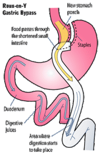 Roux-en-Y-stomach stapled diagram